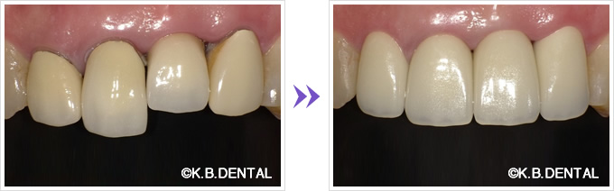 クローズアップ：前歯4本をセラミック