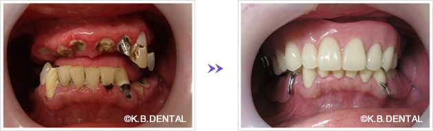 正面：術前術後