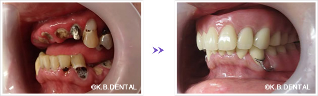 左側：術前術後