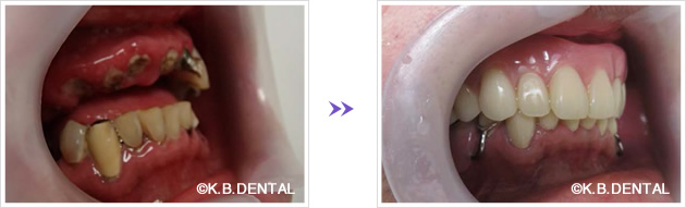 右側：術前術後