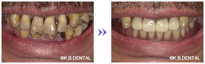 ノンクラスプデンチャー