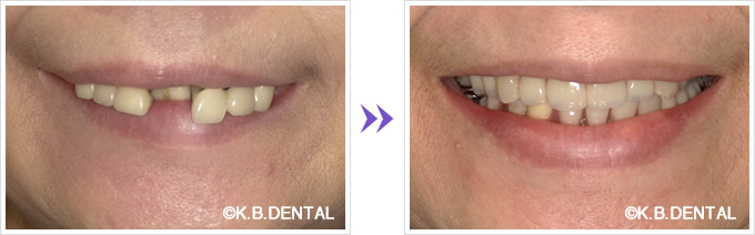 ノンクラスプデンチャー口元