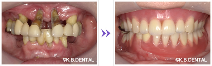 ノンクラスプデンチャー術前術後