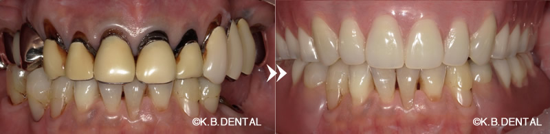 マグネットによるアタッチメント＋金属床（チタン）無口蓋義歯