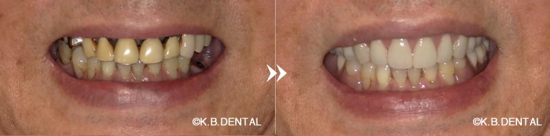 ノンクラスプデンチャー