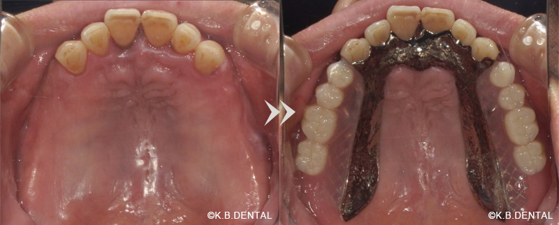 部分金属床（チタン）無口蓋義歯＋特殊維持装置