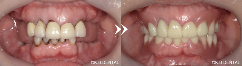 前歯部分ジルコニアクラウン＋ノンクラスプデンチャー