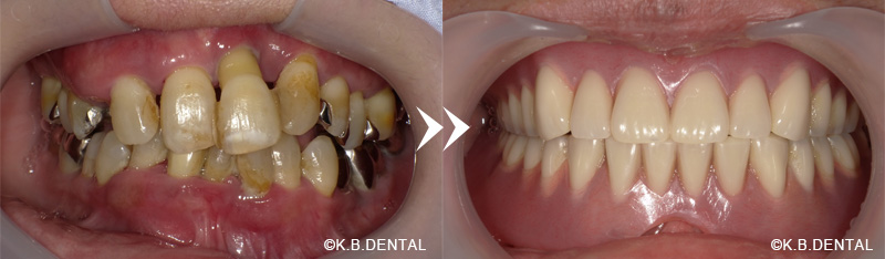 金属床総義歯（チタン）
