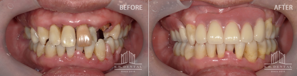 正面：インプラントオーバーデンチャー