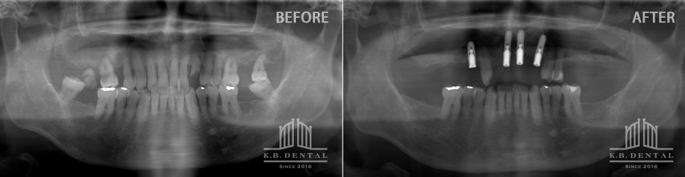 レントゲン：インプラントオーバーデンチャー