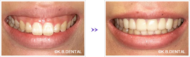 歯肉切除＋セラミック矯正ガミースマイル症例