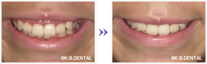 ボツリヌストキシンガミースマイル症例