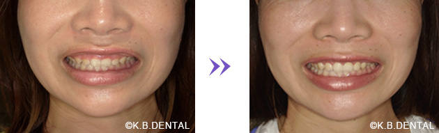 歯肉切除のみで対応する方法