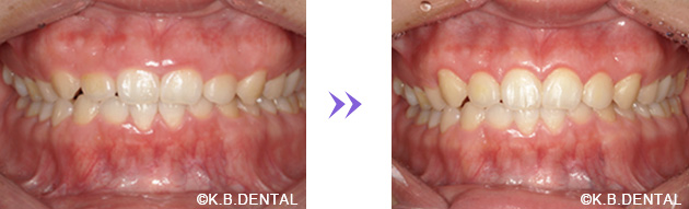 歯肉切除のみで対応する方法