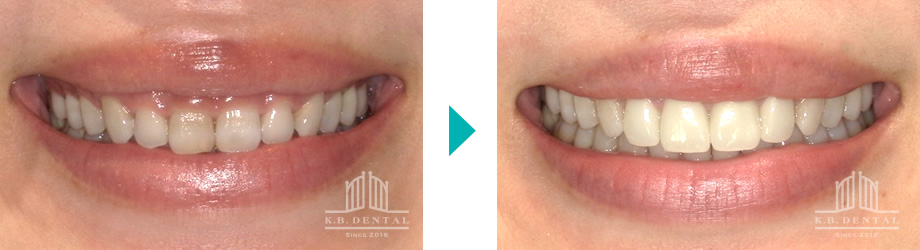 歯肉切除＋ラミネートベニア