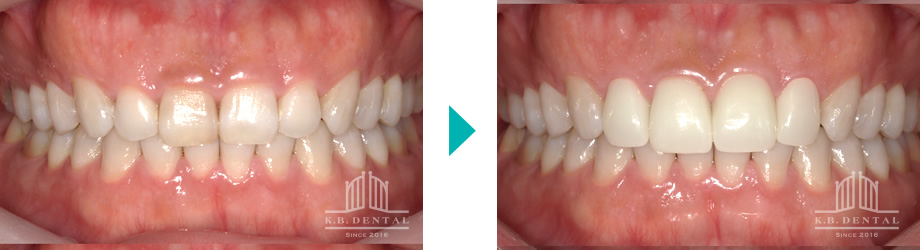 歯肉切除＋ラミネートベニア