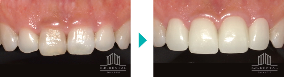 歯肉切除＋ラミネートベニア