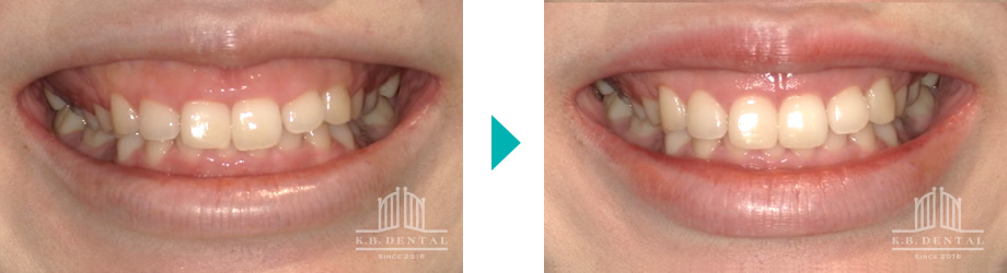 歯肉切除ガミースマイル