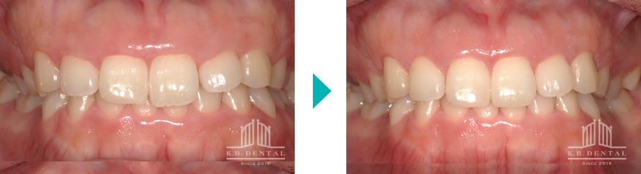 歯肉切除ガミースマイル