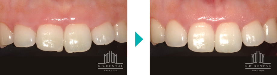 歯肉切除ガミースマイル