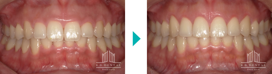歯肉切除＋歯冠形態修正ガミースマイル