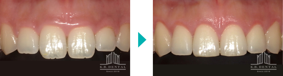 歯肉切除＋歯冠形態修正ガミースマイル
