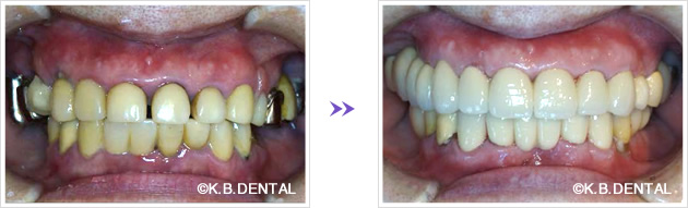 重度歯周病術前術後