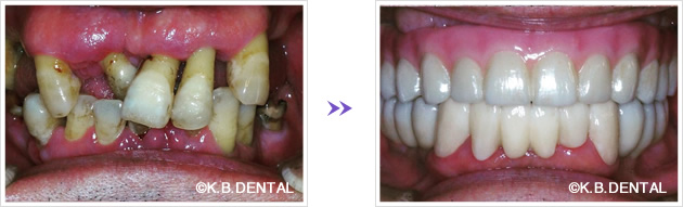 ボロボロの歯術前術後