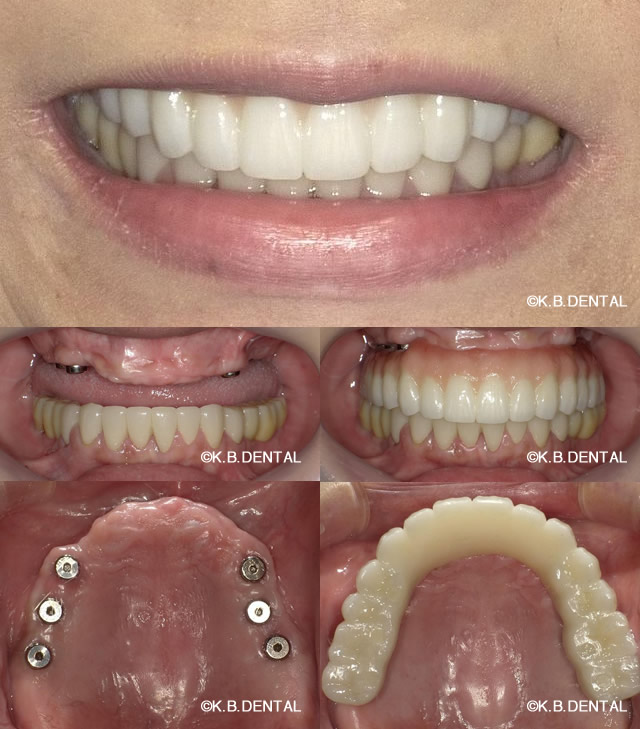 インプラントとフルブリッジ症例