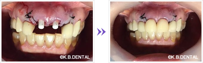 前歯ジルコニアインプラント