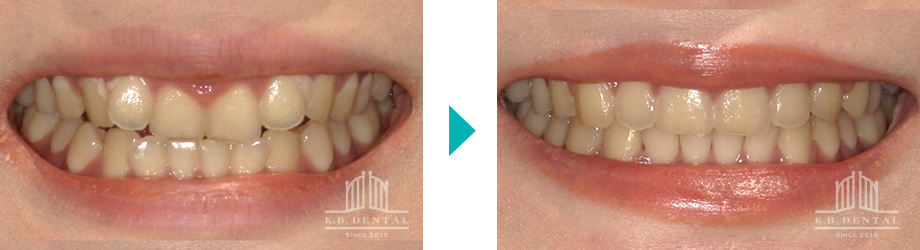 交叉咬合＋開咬