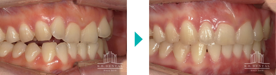 交叉咬合＋開咬