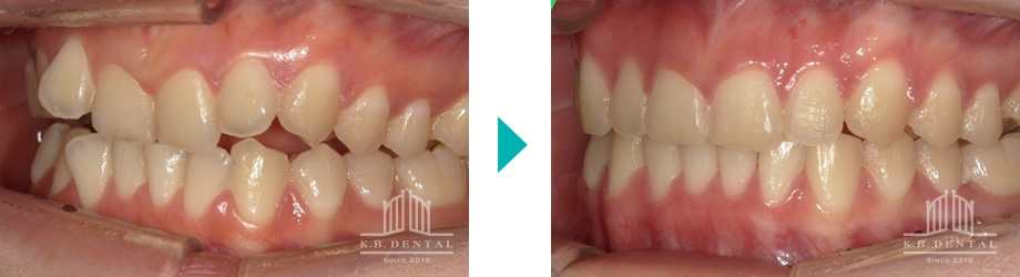 交叉咬合＋開咬