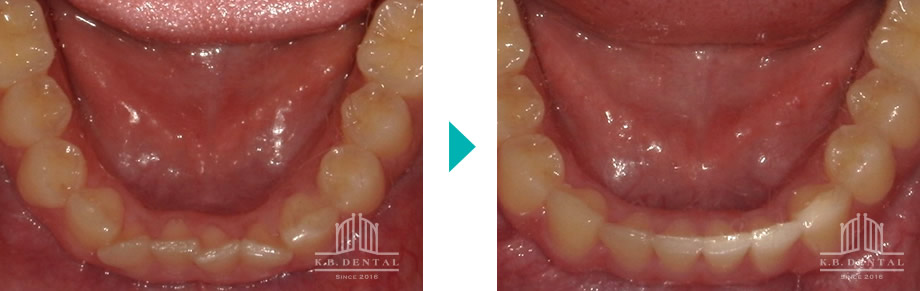 交叉咬合＋開咬