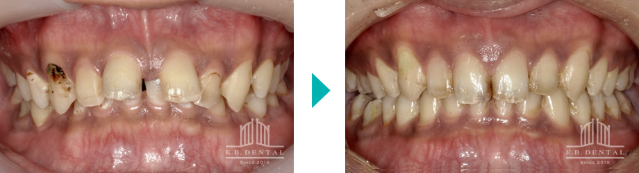 ディープバイト