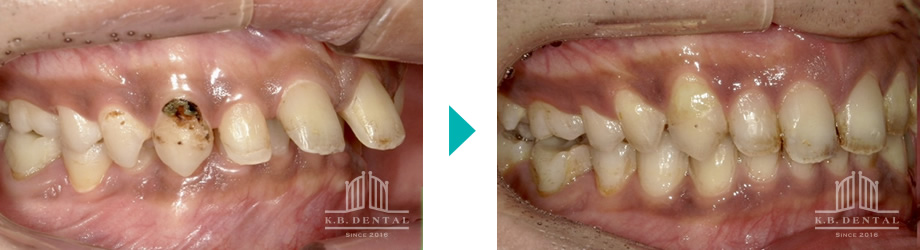 ディープバイト