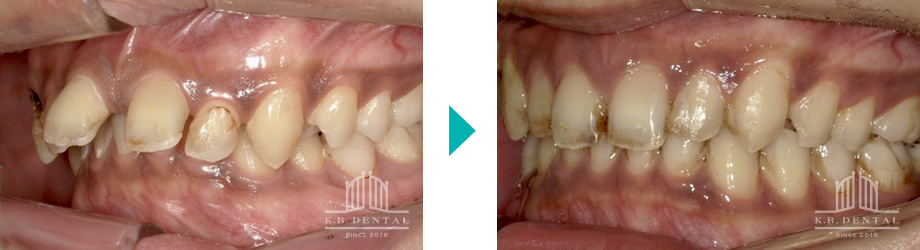 ディープバイト