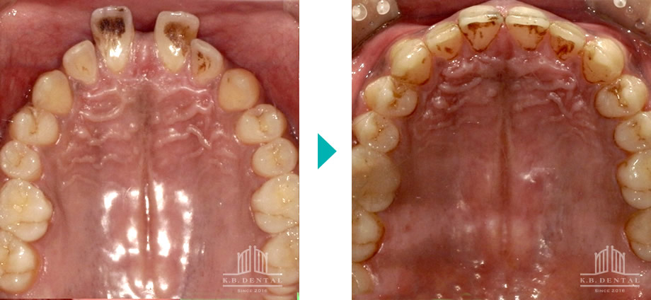 ディープバイト