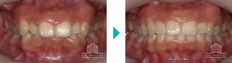 ディープバイト