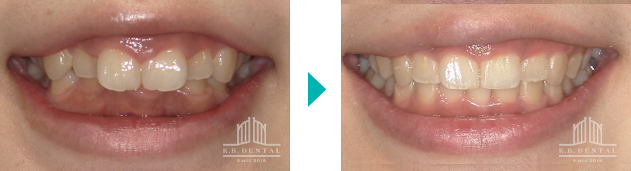 ディープバイト