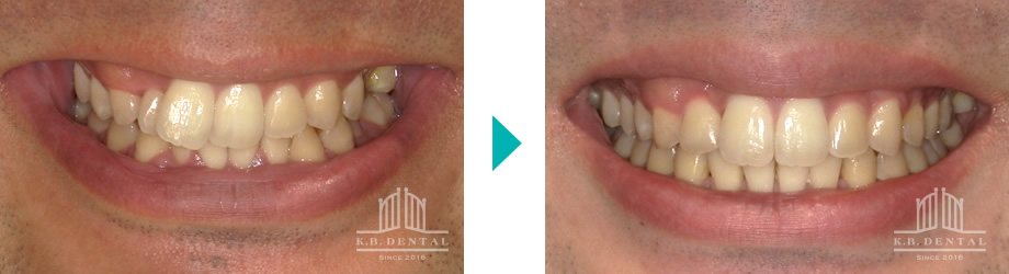 上下前歯部叢生