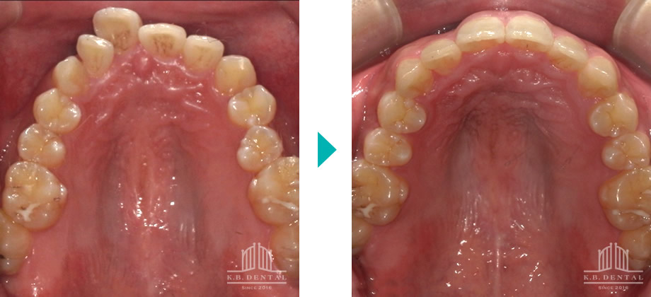 上下前歯部叢生