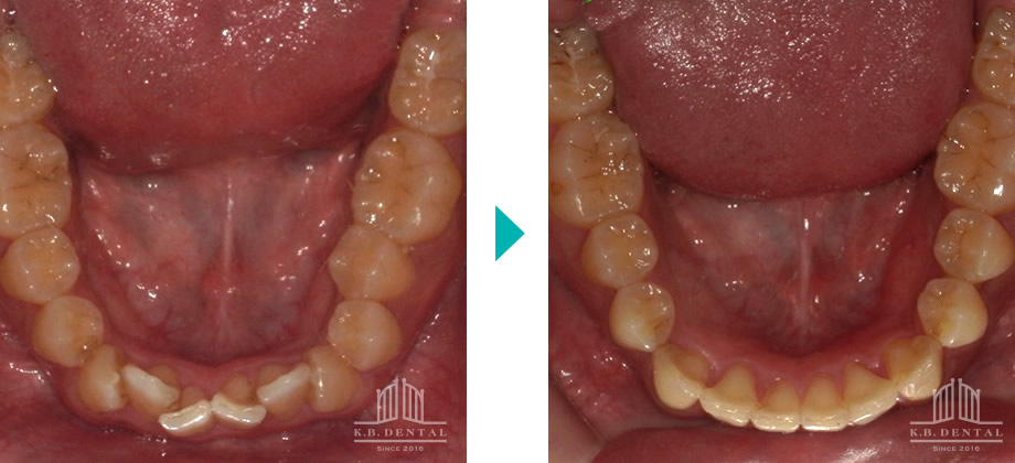 上下前歯部叢生