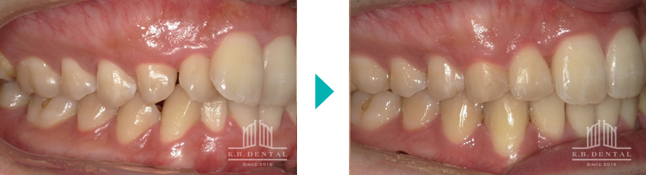 上下前歯部叢生