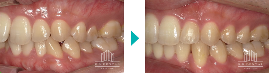 上下前歯部叢生