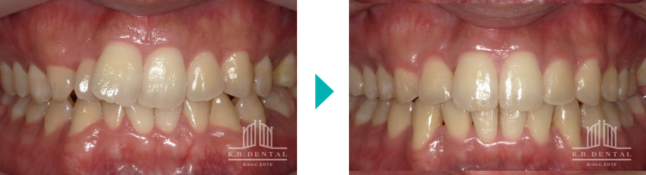 上下前歯部叢生