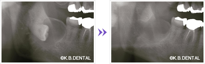 埋伏抜歯＋顎骨腫瘍摘出術