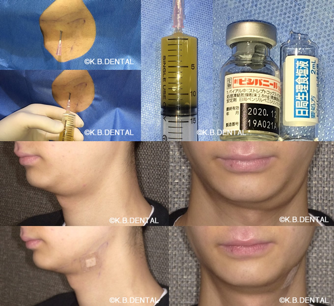 顎下型ガマ腫男性