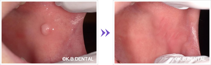 頬粘膜腫瘍摘出