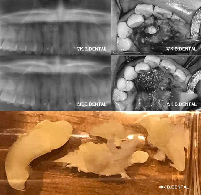 集合性歯牙腫摘出術